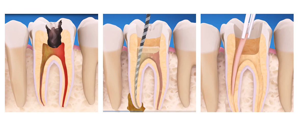 ¿Qué es la endodoncia o "matar el nervio"?