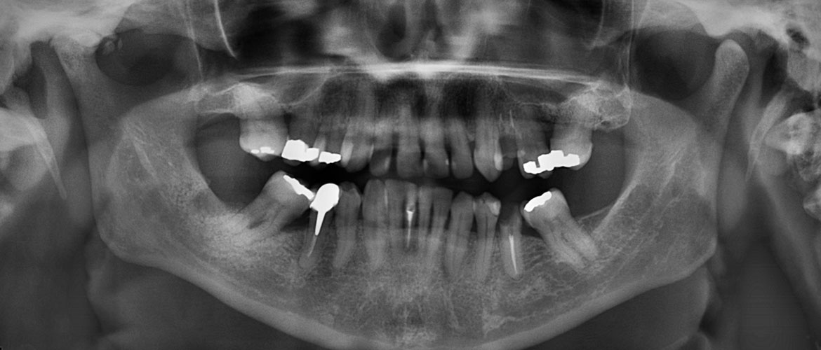 Empaste dental: ¿Qué es, cómo se hace y cuánto dura?
